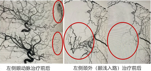 神经管畸形包括哪些疾病 神经管畸形包括哪些疾病