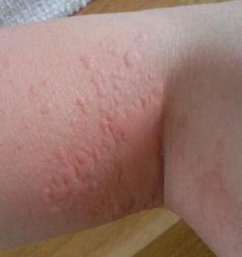 老人身上痒是怎么回事 老人身上痒是怎么回事