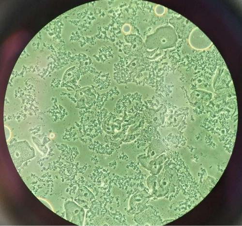 线索细胞阳性可以自愈吗 线索细胞阳性可以自愈吗