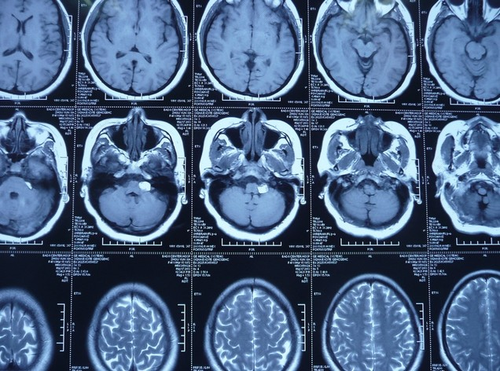 小脑脂肪瘤是怎么得的