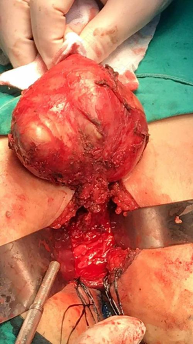 左屁股里面疼怎么回事儿? 左屁股里面疼怎么回事儿?