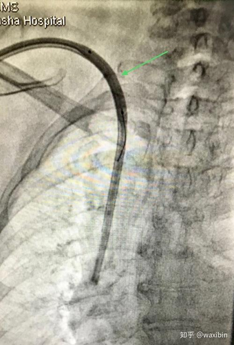 造影剂多久排出体外 造影剂多久排出体外