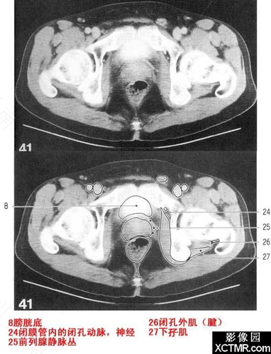 盆腔ct怎么做的疼吗 盆腔ct怎么做的疼吗
