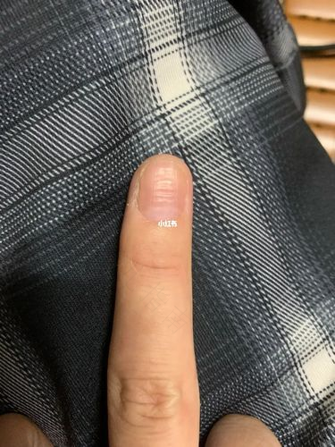 大母脚趾甲往肉里长怎么办 大母脚趾甲往肉里长怎么办