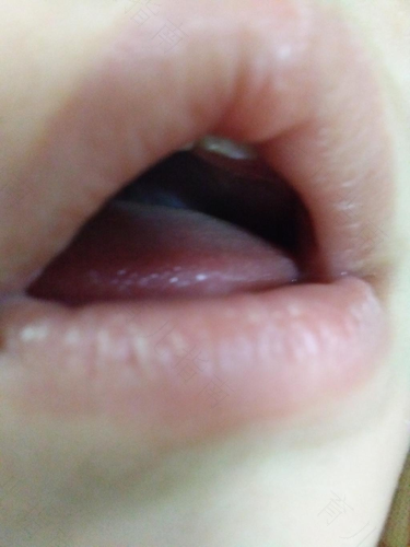 嗓子呼呼响有痰怎么办男孩 嗓子呼呼响有痰怎么办男孩