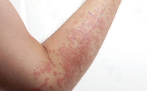 过敏性紫癜能吃土豆丝吗 过敏性紫癜能吃土豆丝吗