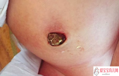肚脐眼有水发臭是怎么回事 肚脐眼有水发臭是怎么回事