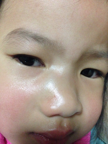 摔到鼻梁肿了怎么办