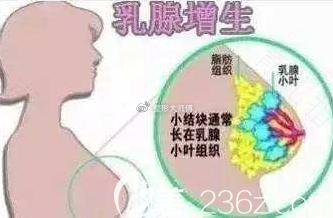 乳腺轻度不典型增生严重吗 乳腺轻度不典型增生严重吗