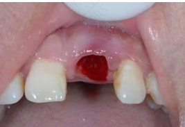 拔牙后可以抽烟吗 知乎 拔牙后可以抽烟吗 知乎