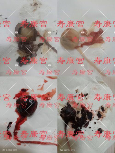 残留20mm能自己排出吗 残留20mm能自己排出吗