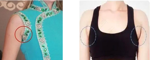 副乳切除后还会再长吗 副乳切除后还会再长吗