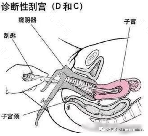 子宫出血能做刮宫手术吗 子宫出血能做刮宫手术吗