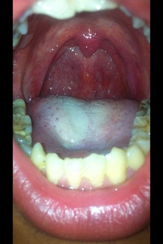 嗓子疼感觉有痰怎么办 嗓子疼感觉有痰怎么办