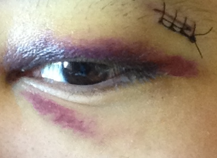 眼窝淤青疼痛怎么回事 眼窝淤青疼痛怎么回事