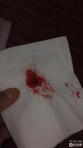 大便太用力出血了怎么办 大便太用力出血了怎么办