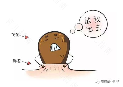 大便干硬堵在肛门怎么办 大便干硬堵在肛门怎么办