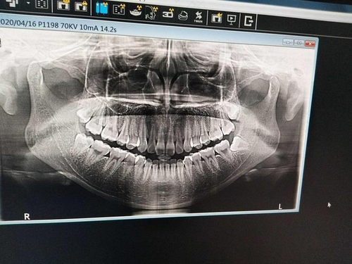 拔上颌智齿需要拍片吗 拔上颌智齿需要拍片吗