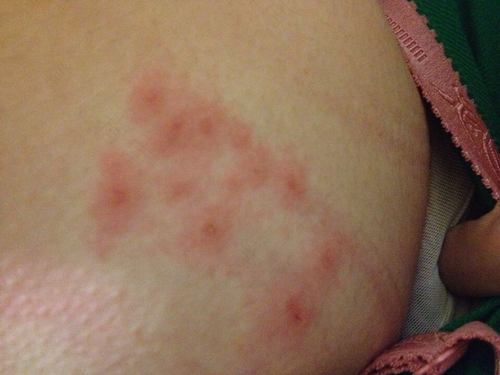 胸口又痒又疼是怎么回事 胸口又痒又疼是怎么回事