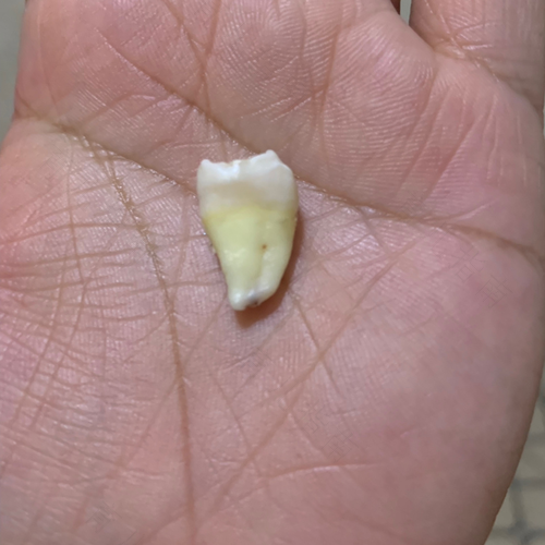 拔智齿后疼多久正常 拔智齿后疼多久正常