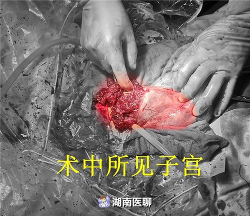 宫内大出血是什么症状 宫内大出血是什么症状