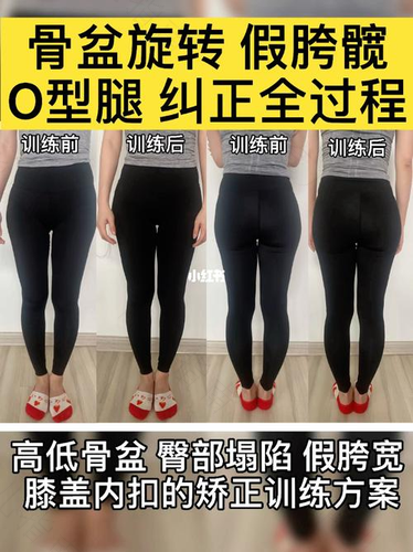 小孩骨盆倾斜能纠正过来吗 小孩骨盆倾斜能纠正过来吗