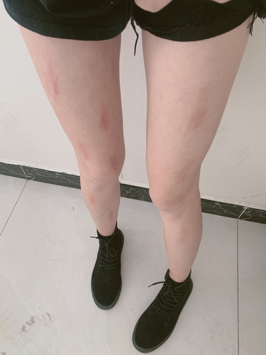 为什么腿会变黑怎么办