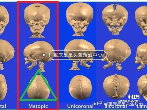 额缝早闭是怎样引起的 额缝早闭是怎样引起的