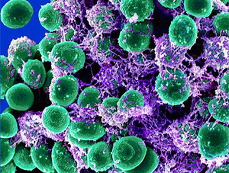 念珠菌感染很痒怎么办 念珠菌感染很痒怎么办