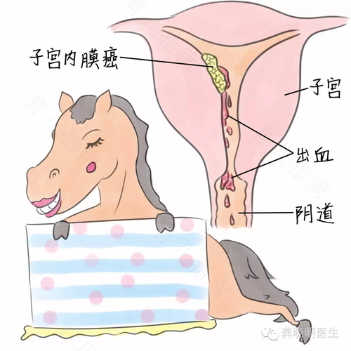 绝经后出血是什么情况 绝经后出血是什么情况