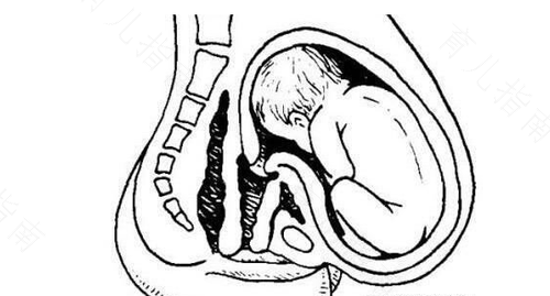 产后悬垂腹怎么恢复 产后悬垂腹怎么恢复