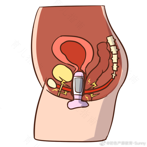 子宫脱垂三度如何治疗好 子宫脱垂三度如何治疗好