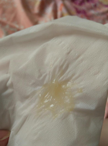 白带发黄粘稠怎么回事 白带发黄粘稠怎么回事