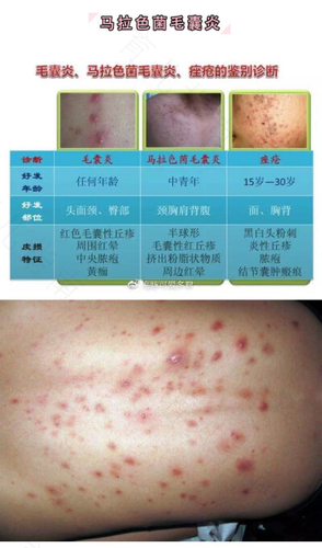 后背毛囊炎怎么办知乎 后背毛囊炎怎么办知乎