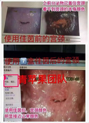 宫颈糜烂怎么样才能根治 宫颈糜烂怎么样才能根治
