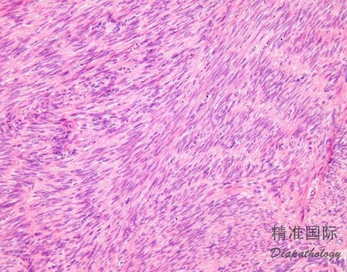 子宫粘膜下平滑肌瘤严重吗 子宫粘膜下平滑肌瘤严重吗