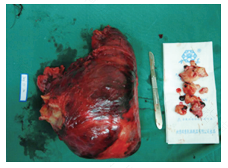 女人切除子宫对身体有害吗 女人切除子宫对身体有害吗