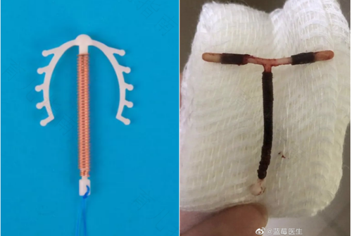 带避孕环腰疼怎么办 带避孕环腰疼怎么办