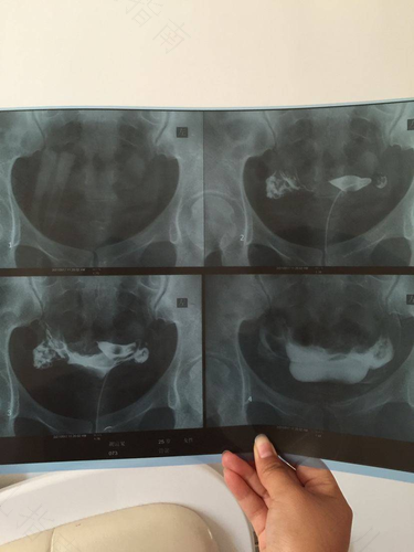 附件炎可以做输卵管造影吗 附件炎可以做输卵管造影吗