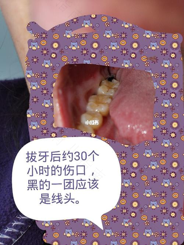 小孩拔牙后疼得厉害怎么办
