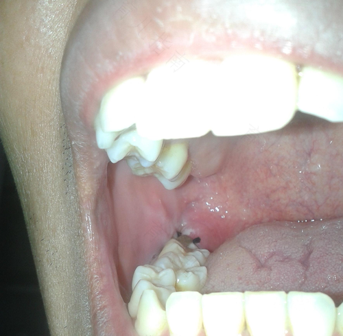 拔智齿伤口感染有哪些症状