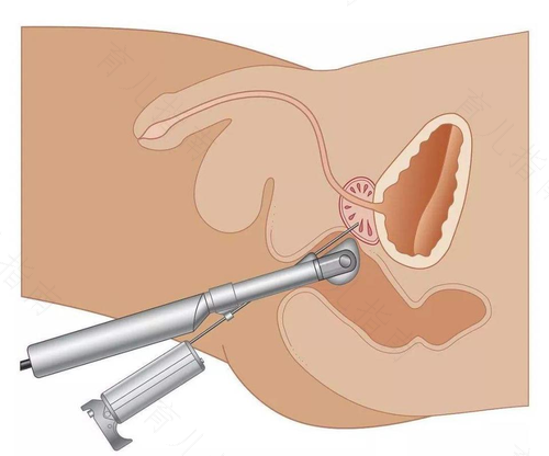 什么情况下需要前列腺穿刺活 什么情况下需要前列腺穿刺活