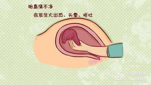 子宫粘连是怎么造成的 子宫粘连是怎么造成的