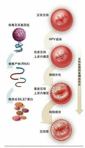 宫颈糜烂分几个等级