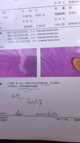 宫颈癌1b期能治愈吗 宫颈癌1b期能治愈吗