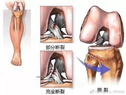 脚踝韧带损伤怎么恢复快 脚踝韧带损伤怎么恢复快