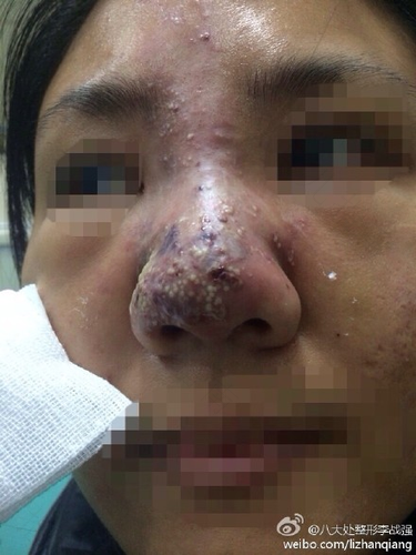 鼻头溃烂是怎么回事 鼻头溃烂是怎么回事