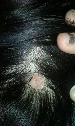 为什么会得寻常疣病 为什么会得寻常疣病