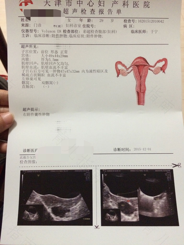 子宫囊肿的症状表现 子宫囊肿的症状表现