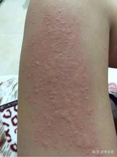 成人接触麻疹病人后怎么办